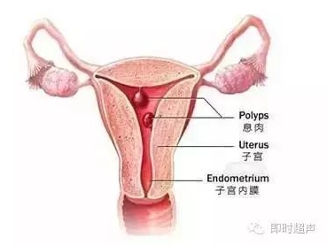 子宫内膜息肉是什么原因导致的？
